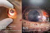 Bệnh viện Bạch Mai cảnh báo 1 tình trạng bệnh ở mắt tăng vọt ngay trong 3 ngày đầu năm 2026