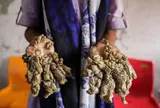 Dị nhân với đôi tay mọc như rễ cây: Căn bệnh hiếm với 25 ca phẫu thuật gây ám ảnh