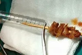 Kích hoạt toàn Bệnh viện Việt Đức cấp cứu bé gái 2,5 tuổi bị que xiên thịt đâm sâu, nguy cơ xuyên sọ não