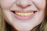 Chuyên gia chỉ ra 4 thực phẩm làm răng ố vàng, đánh mãi vẫn không trắng