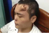 Người đàn ông có chiếc mũi "mọc" giữa trán, sự thật phía sau gây bất ngờ
