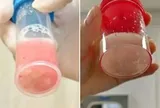 Cô bé 12 tuổi phổi trắng xóa và đông đặc sau 1 ngày bị sốt, bác sĩ cảnh báo: Đừng lúc nào cũng tưởng con cảm lạnh!