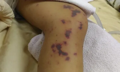 TP.HCM phát cảnh báo bệnh não mô cầu, Hà Nội ghi nhận thêm 1 trường hợp