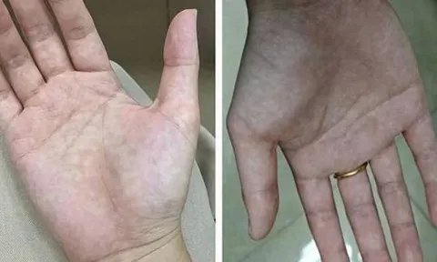 Bàn tay là tín hiệu cảnh báo sức khỏe: 1 thay đổi có thể cho thấy bệnh tiểu đường hoặc xơ gan
