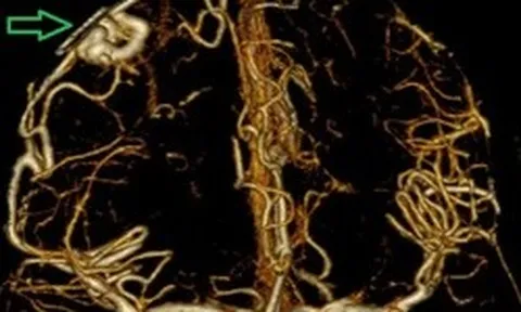 Bác sĩ cảnh báo “quả bom nổ chậm” trong não: Người trẻ dễ chủ quan với dấu hiệu này