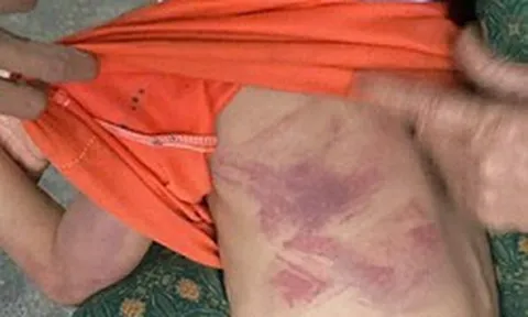 Bé gái lớp 2 bị bạn cùng lớp dùng thước đánh thâm tím người vì không cho kẹo