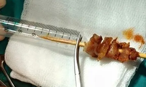 Kích hoạt toàn Bệnh viện Việt Đức cấp cứu bé gái 2,5 tuổi bị que xiên thịt đâm sâu, nguy cơ xuyên sọ não