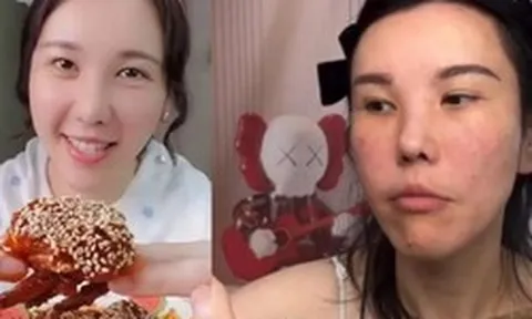 Mặt cô gái trẻ biến dạng sau 2 năm làm mukbang, bác sĩ cảnh báo 4 cái giá phải trả về sức khỏe ít ai biết đến