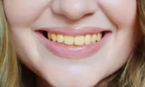 Chuyên gia chỉ ra 4 thực phẩm làm răng ố vàng, đánh mãi vẫn không trắng