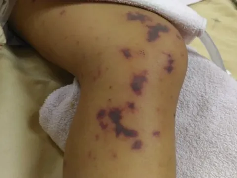 TP.HCM phát cảnh báo bệnh não mô cầu, Hà Nội ghi nhận thêm 1 trường hợp