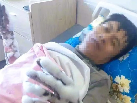 Thanh Hóa thông tin vụ nam công nhân bị điện phóng bỏng nặng 2 tay