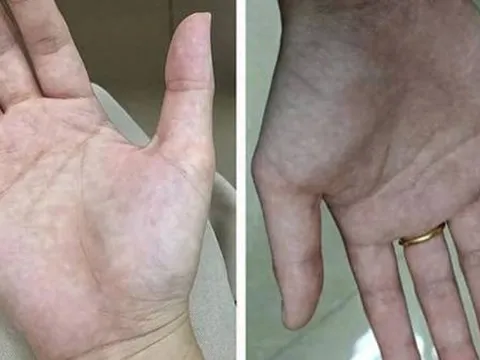 Bàn tay là tín hiệu cảnh báo sức khỏe: 1 thay đổi có thể cho thấy bệnh tiểu đường hoặc xơ gan