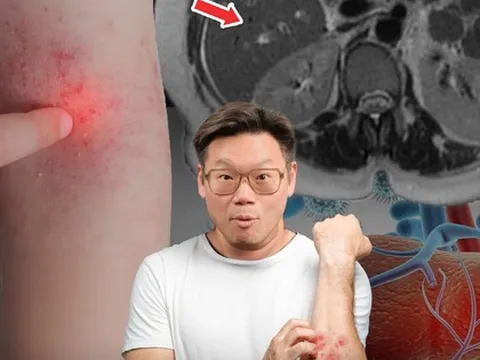 Phó Giám đốc Bệnh viện Thái Lan cảnh báo 4 dấu hiệu trên da là "lời kêu cứu" của gan, nhiều người bỏ qua rồi hối hận không kịp