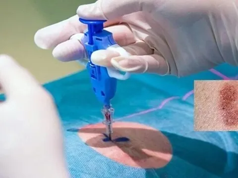 Ung thư da: Nguy hiểm tiềm ẩn từ những tổn thương không đau, không ngứa