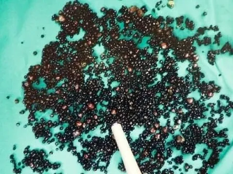 5000 viên sỏi lấp kín túi mật người đàn ông: Bác sĩ nói thẳng: "3 thói quen này là nguyên nhân"