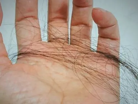 Một phụ nữ giảm được 10kg nhưng lại bị hói đầu: Bác sĩ tiết lộ 4 nguyên nhân chính không ai ngờ