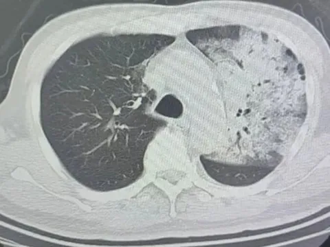 Người đàn ông sốt 40 độ C, phổi gần như 'trắng xóa", chỉ vài ngày đã suy đa tạng: Thủ phạm liên quan đến thói quen nhiều gia đình vẫn mắc