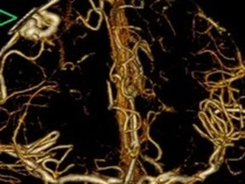 Bác sĩ cảnh báo “quả bom nổ chậm” trong não: Người trẻ dễ chủ quan với dấu hiệu này