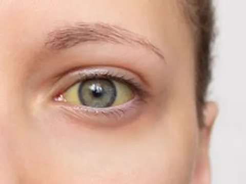 Cảnh báo 4 dấu hiệu của loại ung thư "sát thủ thầm lặng": Nếu có phải đi khám ngay