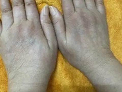 Nữ doanh nhân có 1 dấu hiệu lạ ở tay nhiều năm: Đi khám bác sĩ cảnh báo hàng loạt tạng đang "gặp nguy"