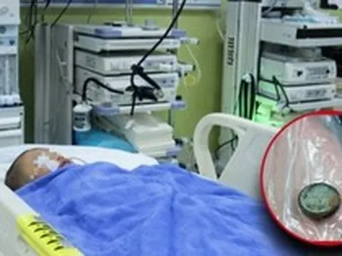 Bé trai 3 tuổi nuốt phải pin cúc áo, mẹ cho uống ngay 1 thìa gia vị, đến bệnh viện bác sĩ khen: "Giỏi lắm"