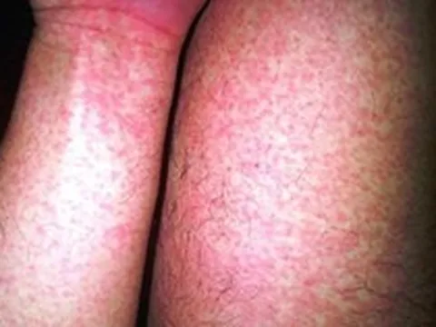 Gần 32.000 ca mắc, 4 ca tử vong: Bệnh viện Bạch Mai phát cảnh báo về 1 căn bệnh đang tăng nhanh, có thể suy đa tạng chỉ trong vài ngày