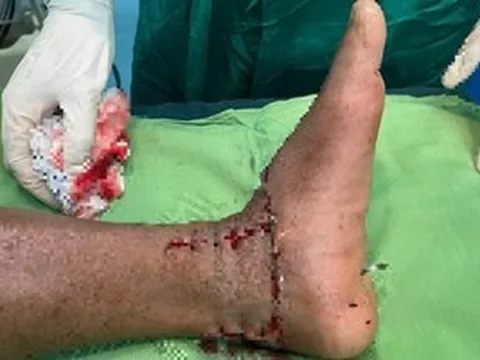 Lưỡi máy phát cỏ gãy, chém đứt lìa bàn chân người đàn ông