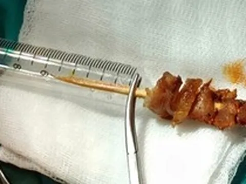 Kích hoạt toàn Bệnh viện Việt Đức cấp cứu bé gái 2,5 tuổi bị que xiên thịt đâm sâu, nguy cơ xuyên sọ não