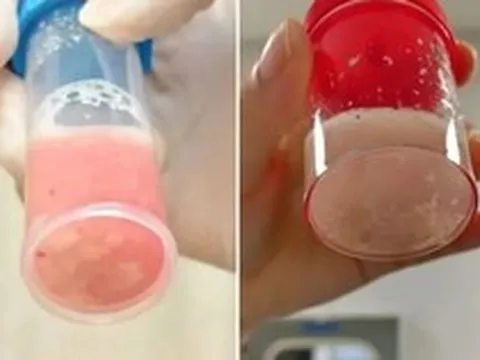 Cô bé 12 tuổi phổi trắng xóa và đông đặc sau 1 ngày bị sốt, bác sĩ cảnh báo: Đừng lúc nào cũng tưởng con cảm lạnh!