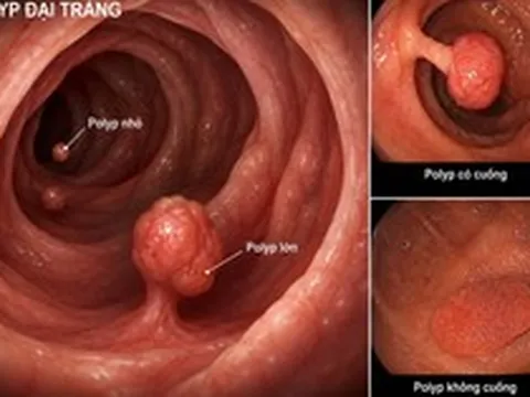 3 thực phẩm quen thuộc, dễ tìm có thể ngăn ngừa polyp đại tràng, nhiều gia đình Việt có sẵn trong bếp