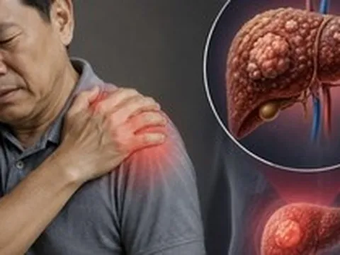 Cảnh báo 1 TÍN HIỆU cực quan trọng của ung thư gan: Nhiều người còn cố cãi chỉ đau vai thông thường