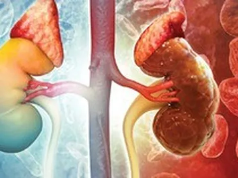 1 thói quen buổi tối có thể khiến thận xuống cấp nhanh chóng: Gặp ở rất nhiều người Việt